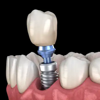 Denal implant in action for lower teeth.