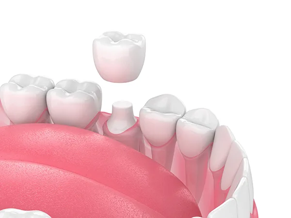 Close up 3D rendering of a shaved down tooth being capped with a porcelain dental crown.