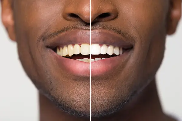 Close up comparison of before and after teeth whitening treatment on a Black man's smile.